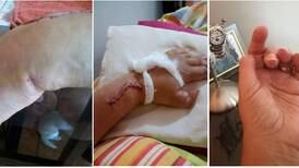Un accidente doméstico requirió tratamiento de tres años: ‘Es un milagro, ya puedo mover mi mano’