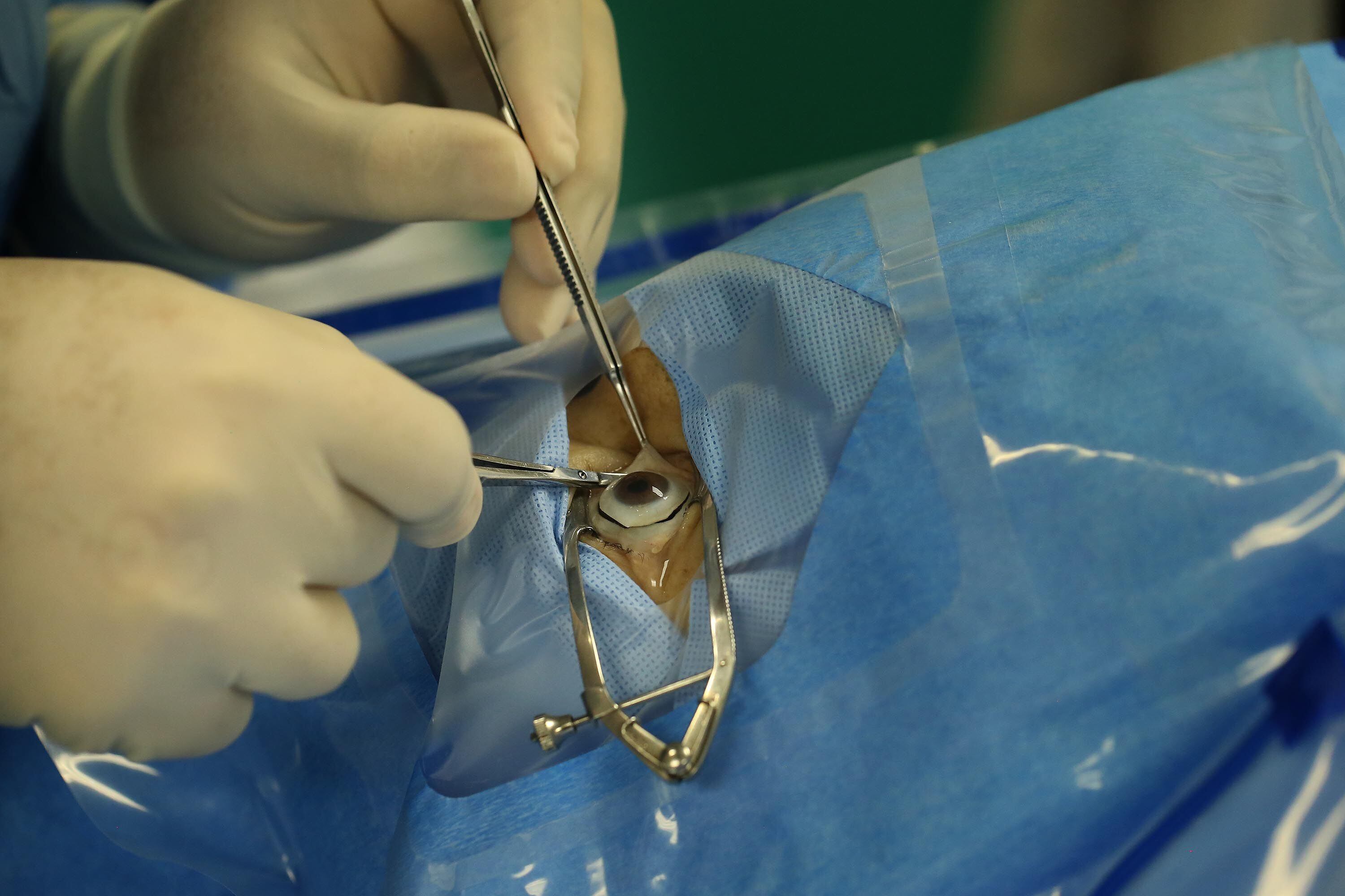 El Hospital San Rafael de Alajuela es uno de los centros procuradores de órganos de la CCSS. En noviembre del 2017, realizaron esta cirugía de extracción de córneas, un procedimiento que no tarda más de 30 minutos.