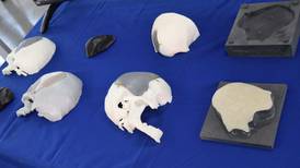 Pacientes con lesiones graves en cráneo recibirán prótesis ‘a la medida’ hecha en el INA