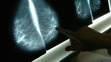 10.500 pacientes aguardan sus resultados de mamografías