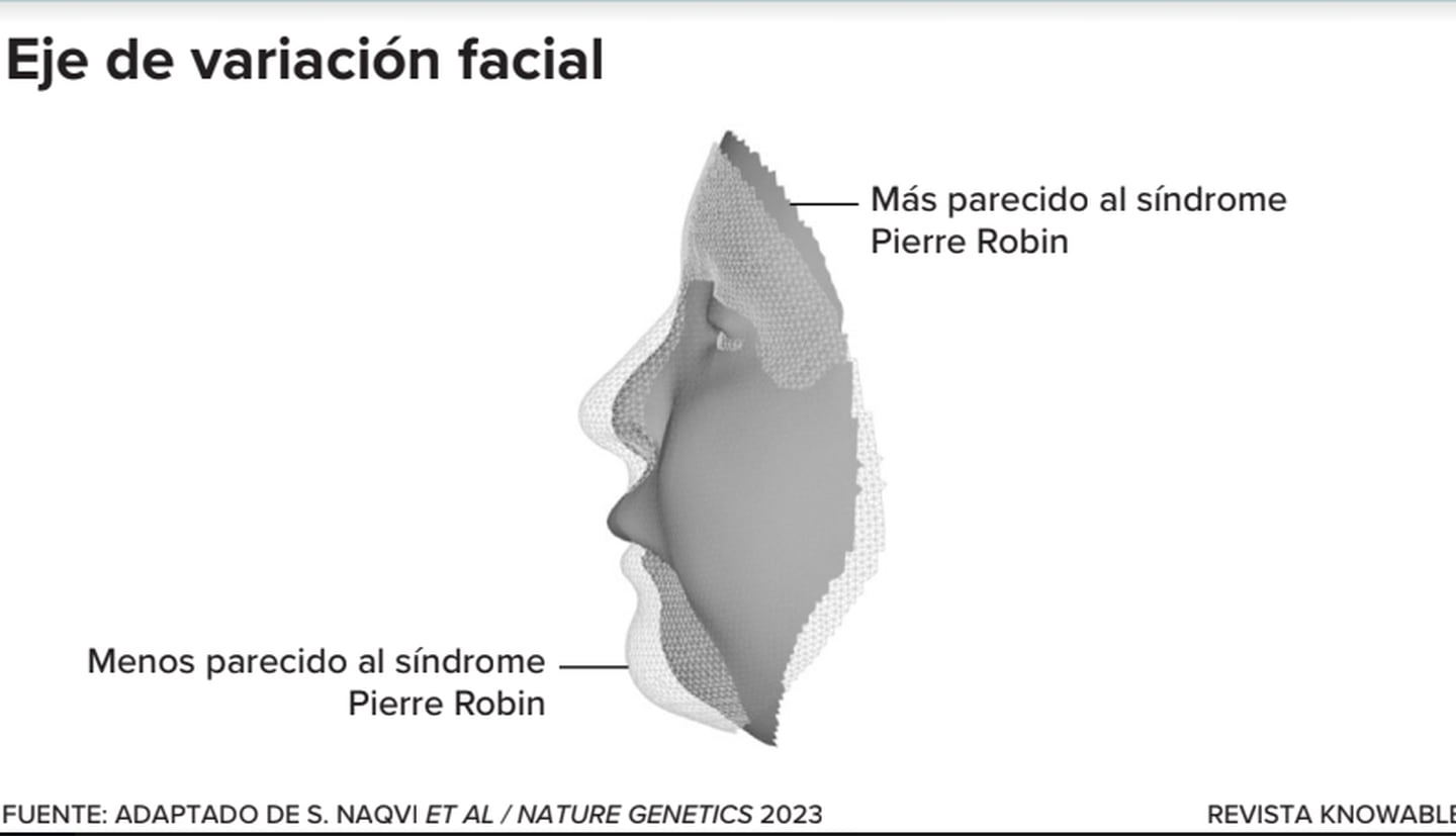 El síndrome de Pierre Robin (PRS) es un trastorno craneofacial caracterizado en parte por una mandíbula inferior pequeña, causado por una mutación en el gen regulador SOX9. Los investigadores clasificaron los rostros normales según si se parece mucho o poco a los rasgos del PRS y luego buscaron variantes genéticas asociadas. Así hallaron que algunos genes son muy sensibles a SOX9, lo que marca la variación facial acercándose o alejándose de los rasgos similares a los del PRS. Si otros ejes de variación facial se determinan de manera similar, esto podría significar que la genética de los rostros puede ser más simple de lo que parece.