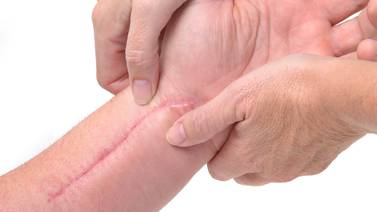 Preste atención a sus cicatrices para prevenir enfermedades serias
