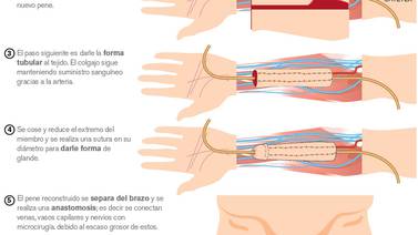 Médicos de Costa Rica reconstruyen  pene con tejidos de brazo