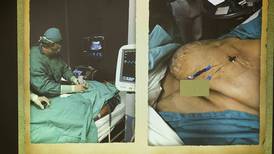 Cirujanos ticos tratan hernia gigante con técnica única en la región centroamericana