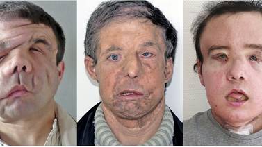 Hombre francés se convierte en la primera persona en recibir segundo trasplante de cara