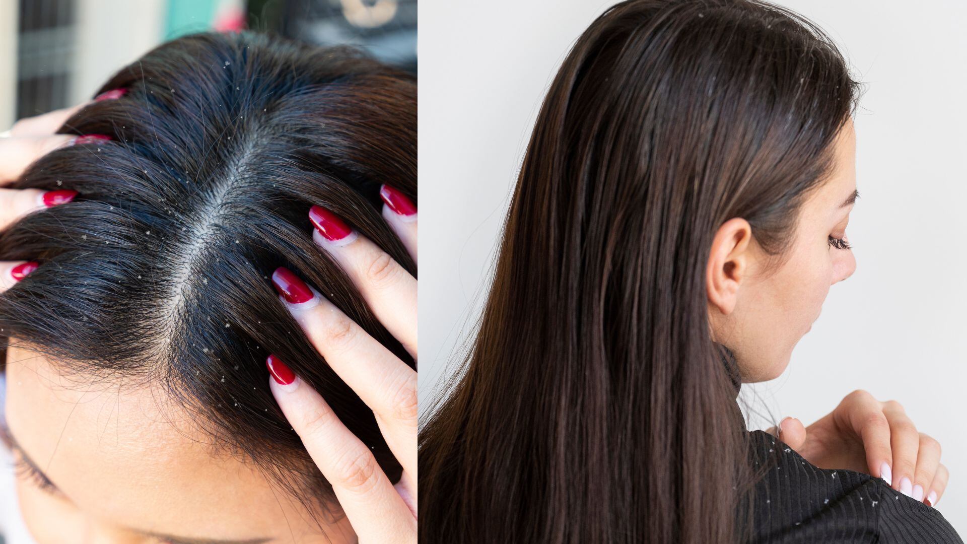 Consultar a un dermatólogo puede ayudar significativamente a reducir la presencia de caspa y mejorar la salud del cuero cabelludo.
