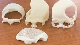 Con prótesis en 3D especialistas ticos reconstruyen cráneos lesionados por accidentes o tumores