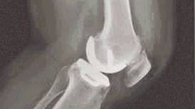 Pequeño implante repone solo parte dañada de una rodilla