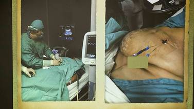 Cirujanos ticos tratan hernia gigante con técnica única en la región centroamericana