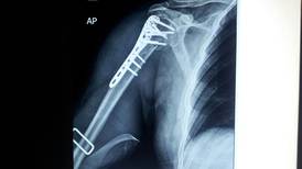   Norval Calvo tras operación en hombro:    <b>‘Me pusieron una platina con 11 tornillos’</b> 