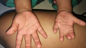 Operación para corregir deformidad en mano de niño fue pospuesta un año por pandemia