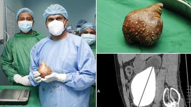 Médicos extirpan cálculo renal más grande del mundo en Sri Lanka: mide 13,37 centímetros