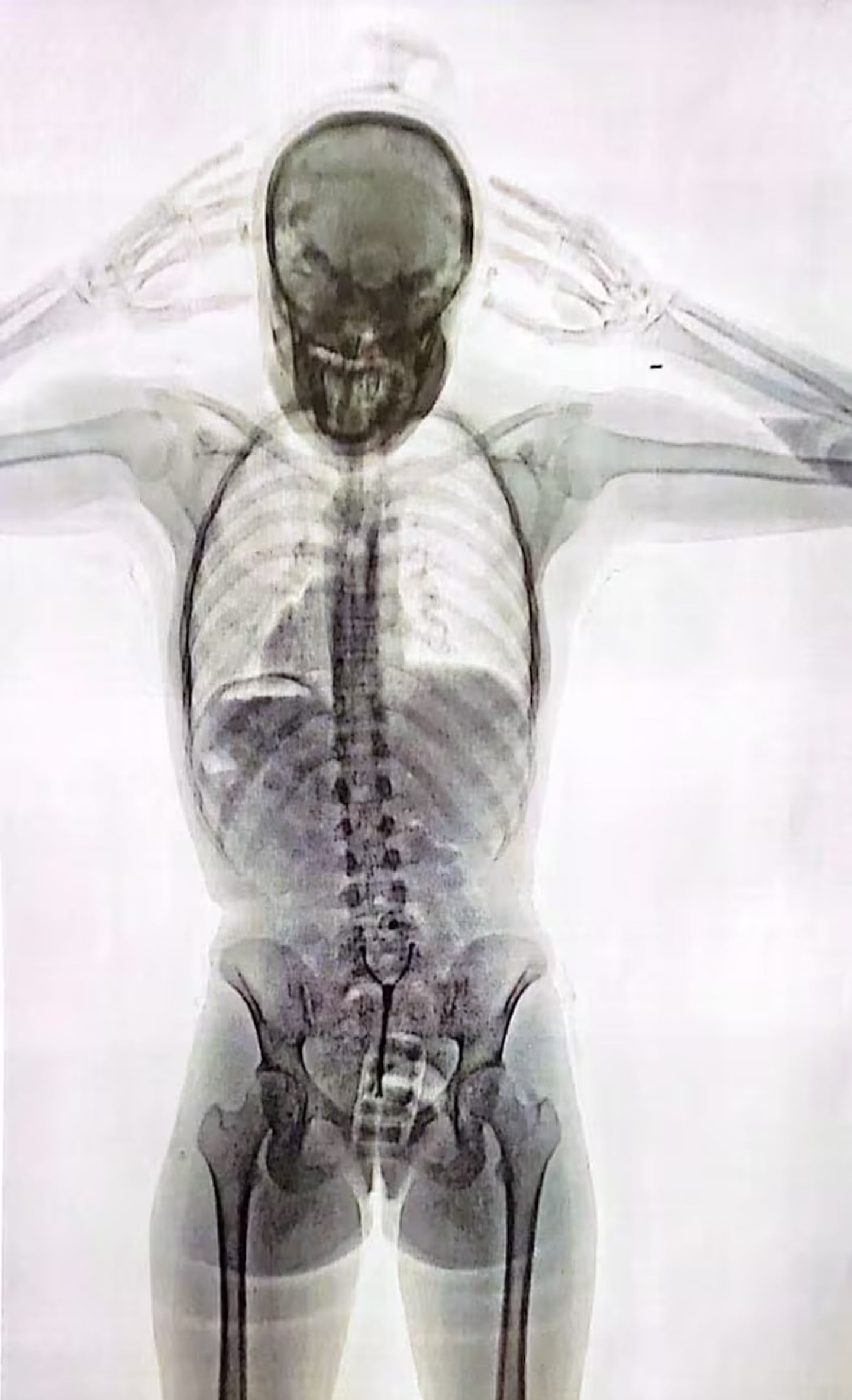La imagen que mostró el escáner del cuerpo de A .S. F., una joven de 20 años que fue utilizada como "mula" por la organización narco investigada. LN, Argentina.