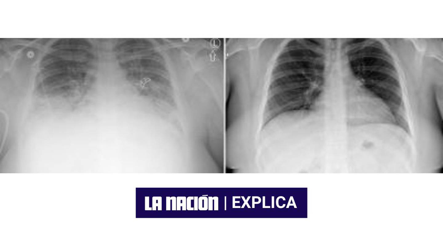 Esta radiografía muestra, a la izquierda, cómo la Evali ataca los pulmones.

Fotografía: Universidad de Utah