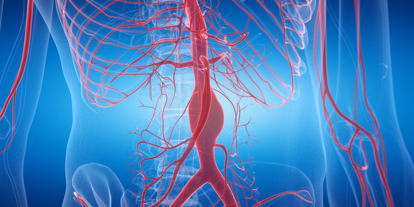 Imagen de un aneurisma de aorta en el abdomen.

Ilustración: Shutterstock