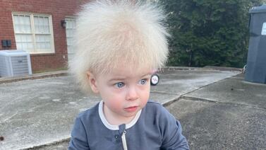 Niño de un año padece ‘síndrome del cabello impeinable’