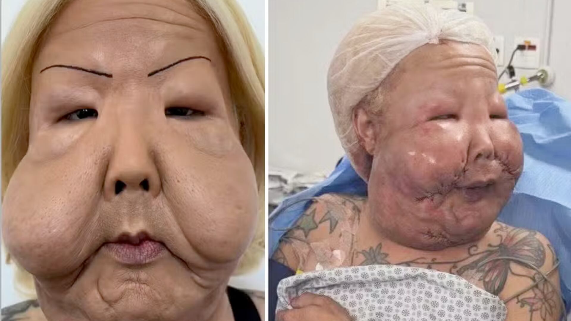 Influencer se somete a cirugía gratuita para remover aceite industrial inyectado en el rostro en 2017 en una clínica clandestina.
