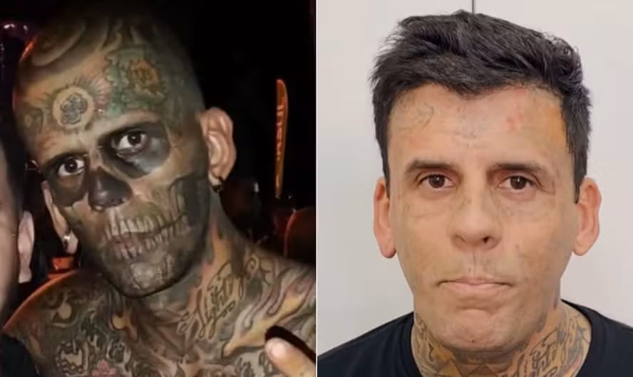 La clínica aplicó múltiples láseres para borrar tatuajes de diferentes colores y marcas en la piel, con una inversión cercana al millón de dólares.