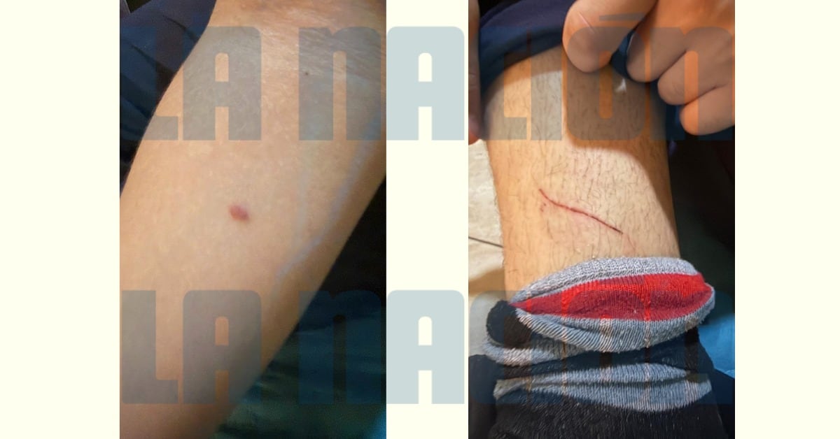 Según la madre, estas son las heridas que los supuestos agresores le hicieron a su hijo. Una es la quemadura con cigarro y la otra el corte con el filo de una navaja.