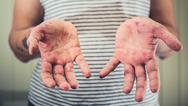 Ministerio de Salud activa protocolo por caso de sarampión en este cantón de San José