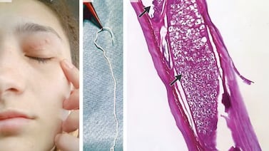 Una mujer se somete a una operación para extraer un gusano vivo de 11 cm de su ojo en Europa