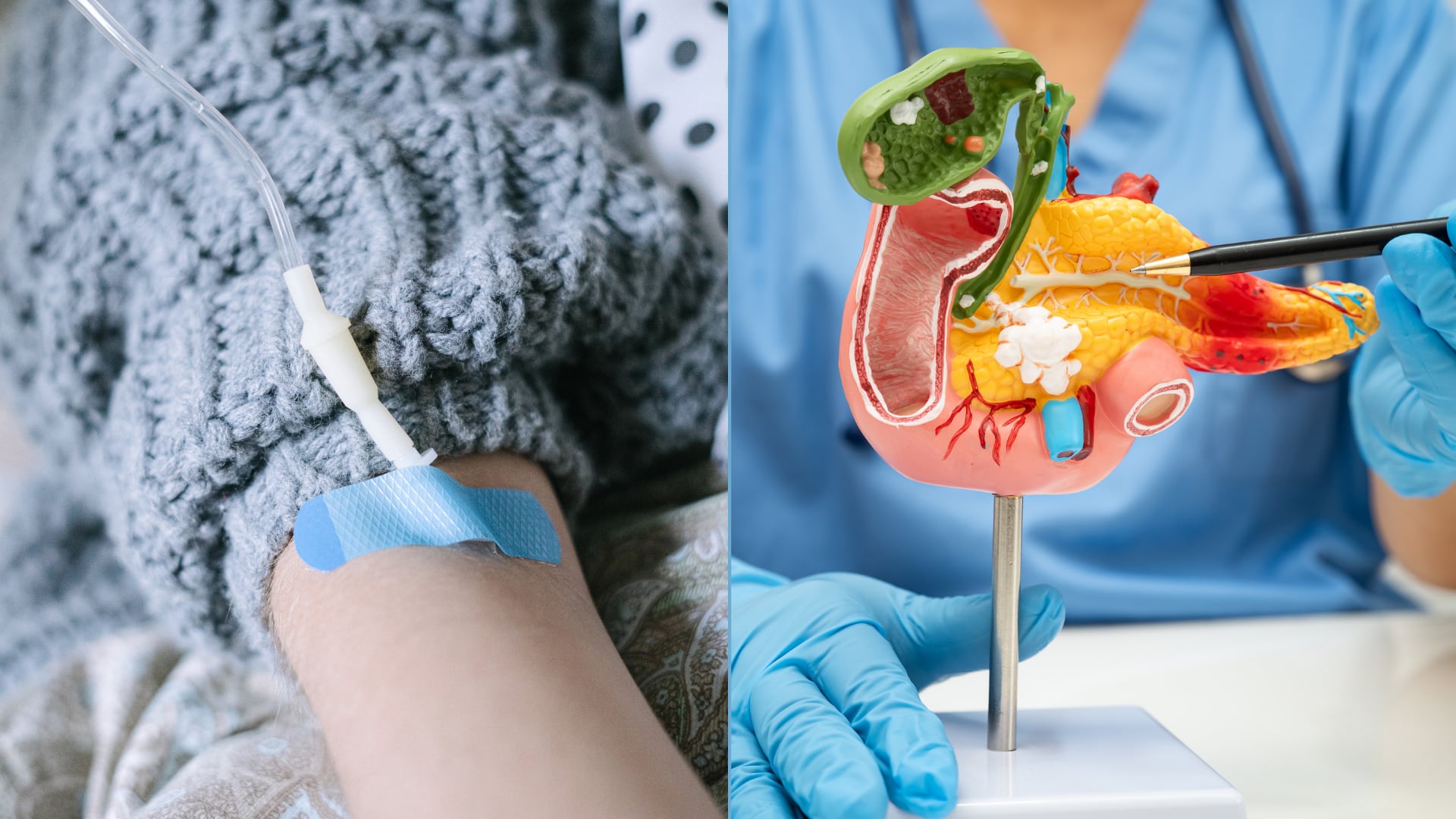 Un estudio en Nature reporta que inhibir netrin1 reduce la resistencia a la quimioterapia en cáncer de páncreas.