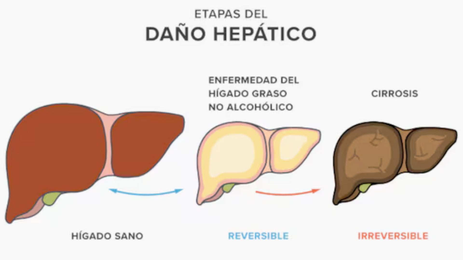 El hígado graso no presenta síntomas visibles, pero puede avanzar hacia enfermedades graves si no se detecta a tiempo con estudios médicos.