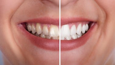 Cómo eliminar el sarro de los dientes de forma segura y efectiva