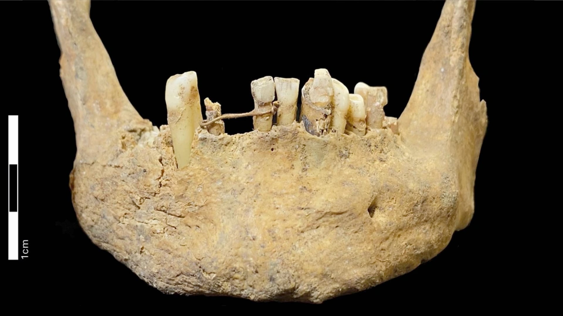 Investigadores descubrieron en Escocia una puente dental medieval hecha con hilo de oro de 20 quilates en restos humanos.