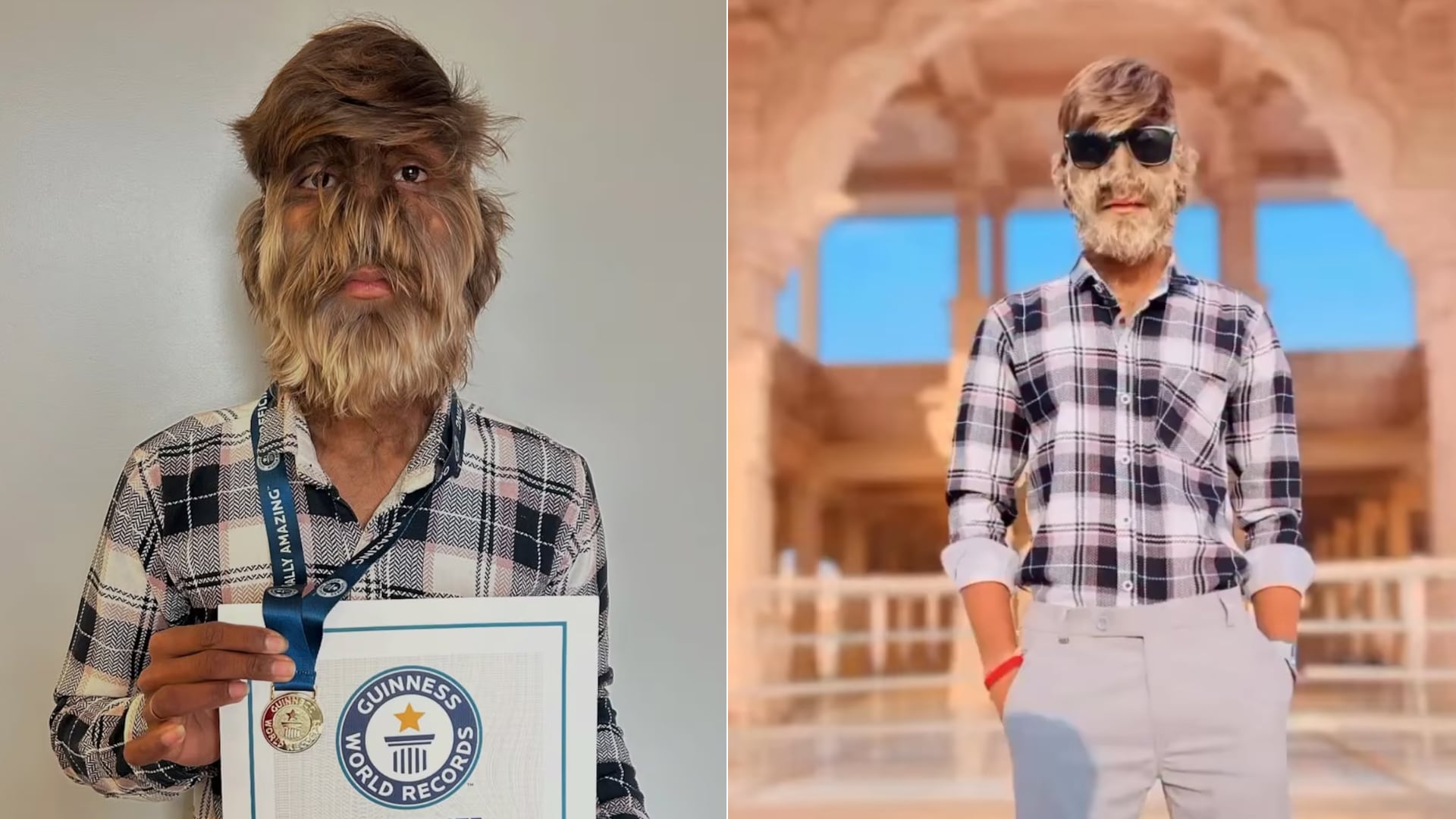 Lalit Patidar transformó una rara enfermedad en fama en redes sociales. El joven con hipertricosis ahora es influencer y suma miles de seguidores.