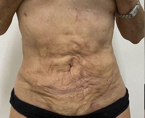Así quedó el abdomen de Gabriela Rossi después de la liposucción.