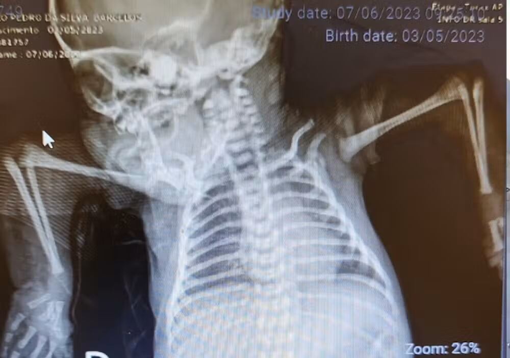 Radiografía muestra la malformación en los brazos de João Pedro causada por artrogriposis, con codos orientados hacia arriba.