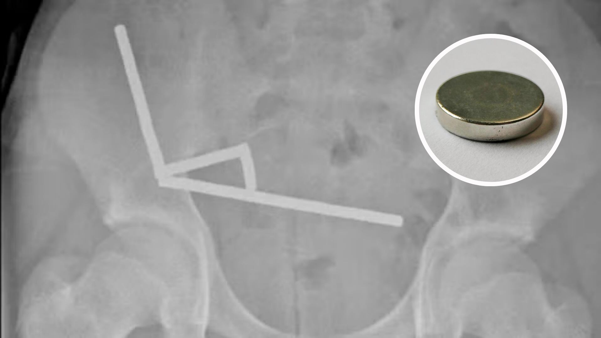 Un menor requirió cirugía urgente tras tragar 200 imanes. El caso reavivó alertas sobre riesgos de productos prohibidos y retos virales.