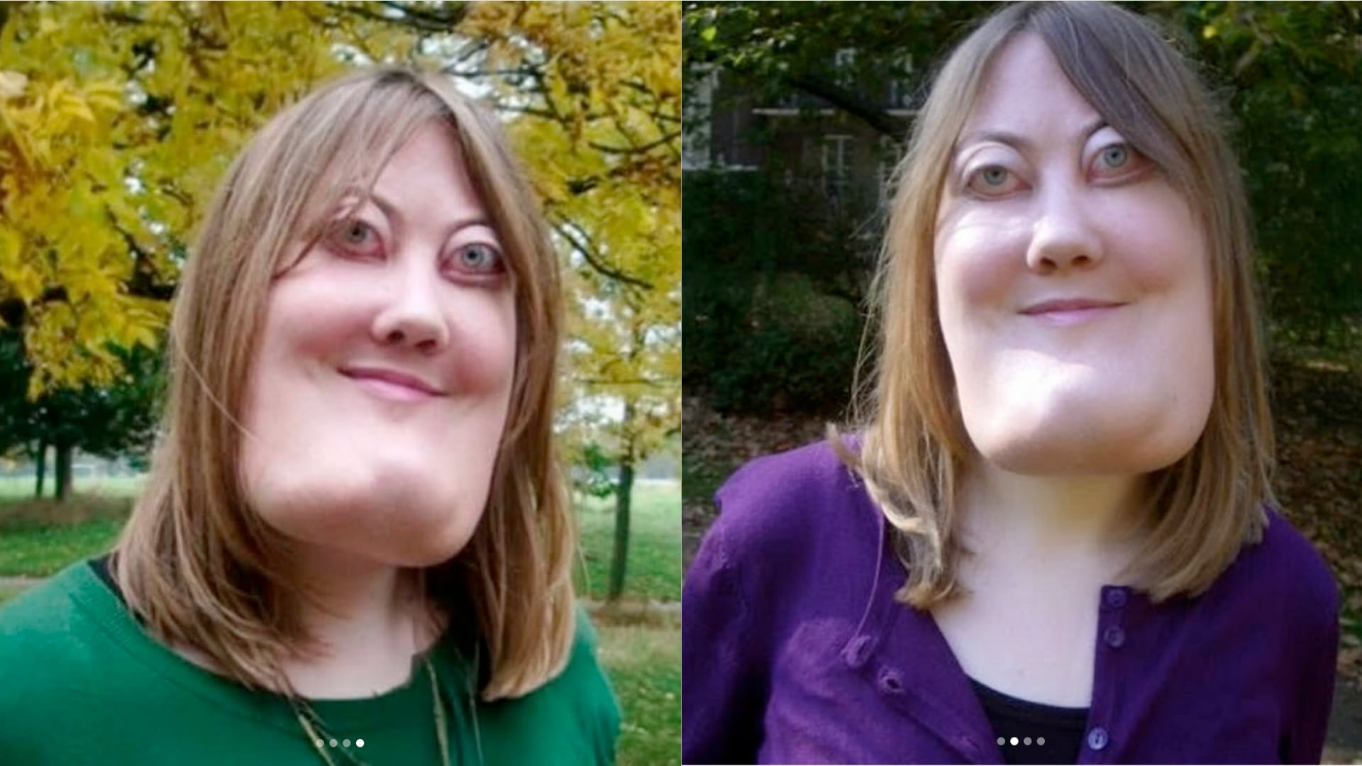 El querubismo es una enfermedad genética poco común que deforma la mandíbula, afecta funciones vitales y provoca discriminación social.