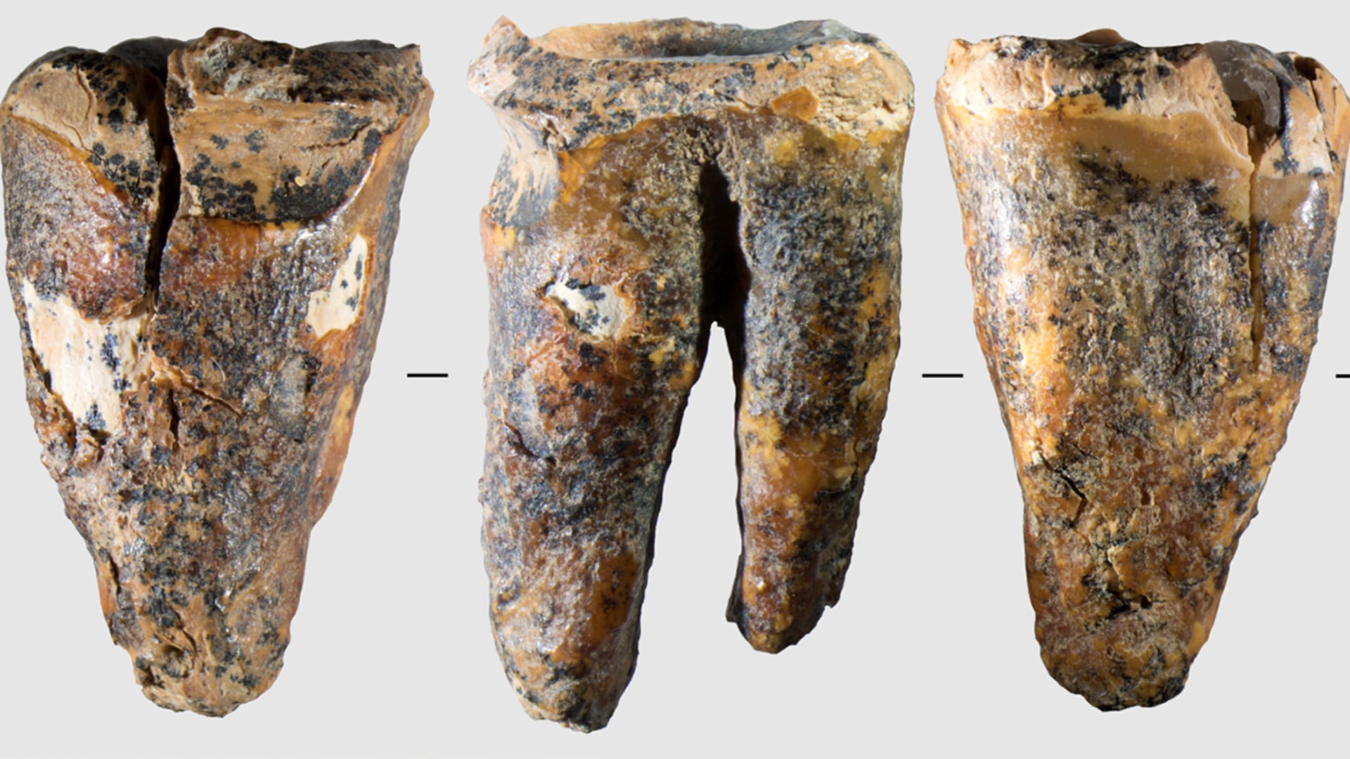 Investigadores encontraron evidencia de que los neandertales trataban caries y alivian dolor dental hace miles de años.