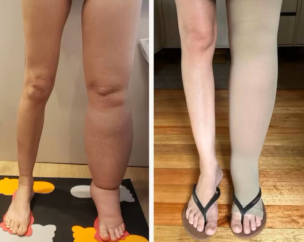 Comparativa del antes y después de Diojane Bentas, mostrando la evolución de su pierna izquierda afectada por linfedema y su recuperación tras implementar un protocolo de tratamiento intensivo que transformó su calidad de vida.