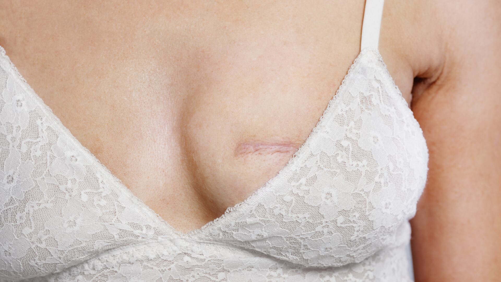 Un estudio científico presenta un implante inyectable que podría cambiar la reconstrucción mamaria al disminuir invasividad y complicaciones tras cirugías por cáncer.