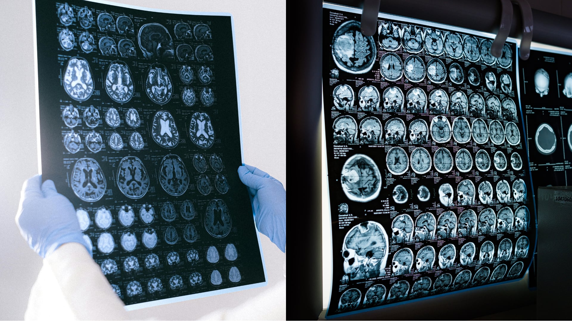 La pérdida de grasa visceral, y no el peso general, predice la salud cerebral. Un estudio asocia este cambio con la preservación del hipocampo.