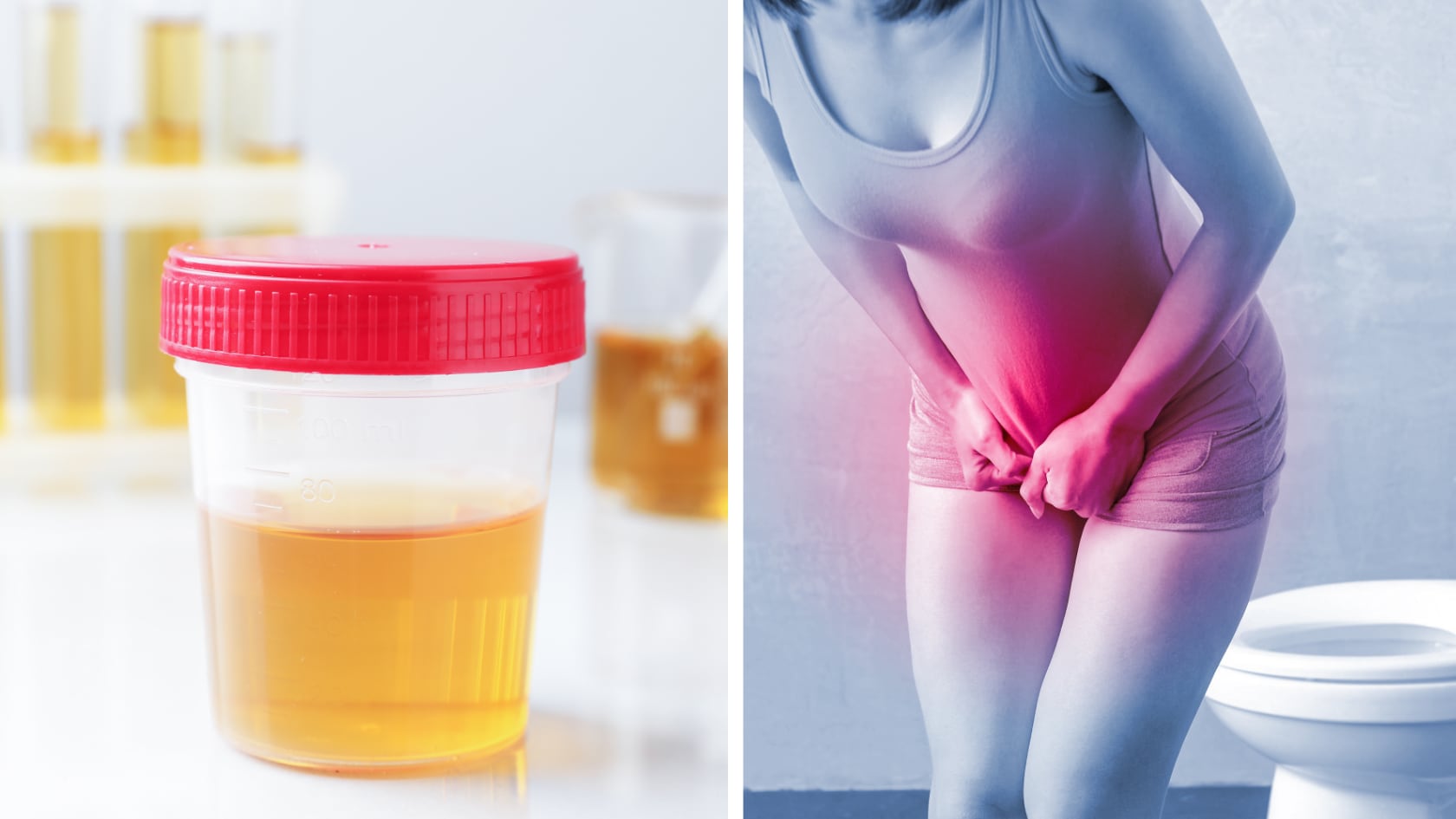 La orina espumosa frecuente puede indicar proteinuria o infecciones. Identificar sus causas permite prevenir complicaciones.