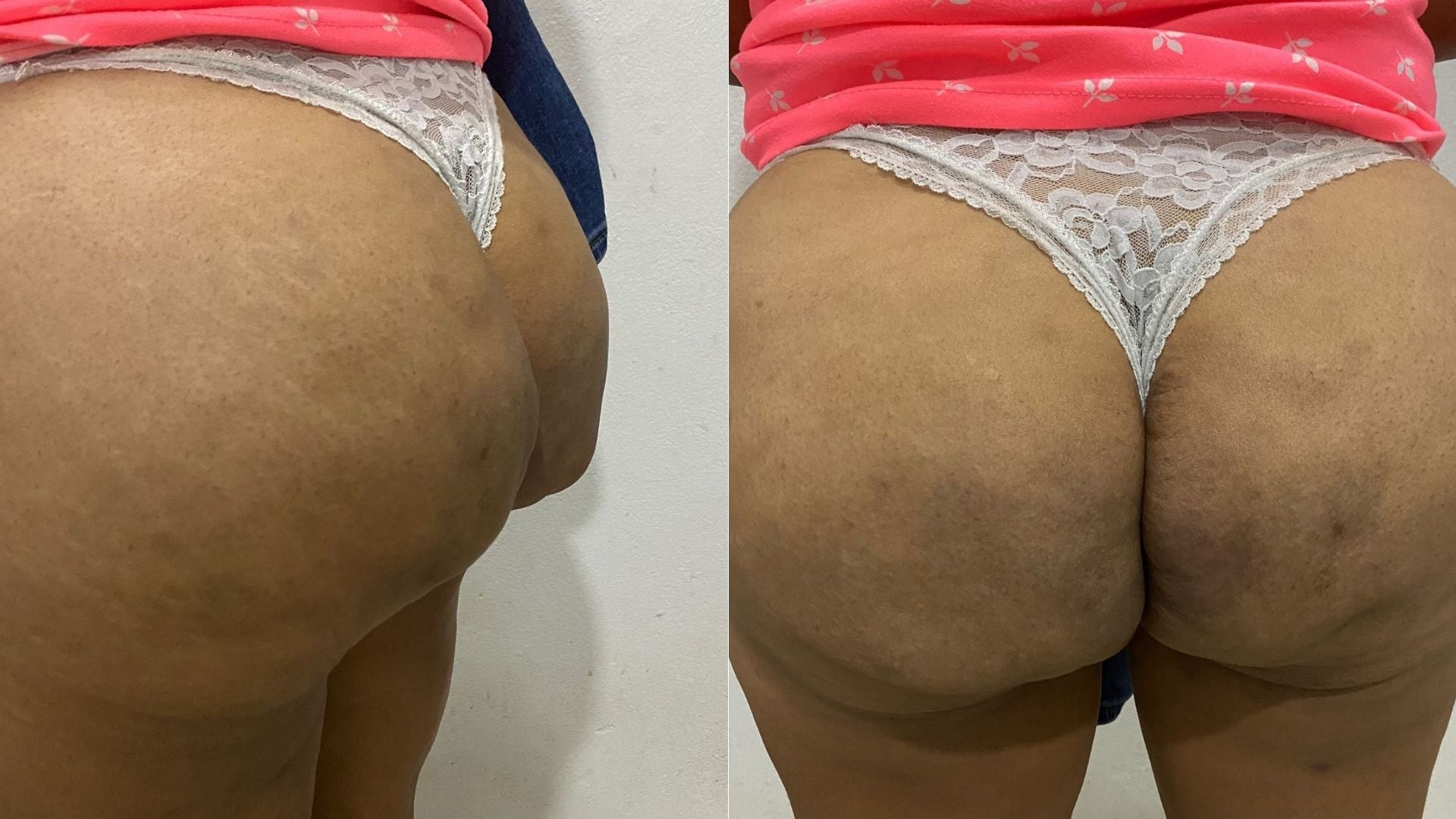 Aumento de glúteos biopolímeros