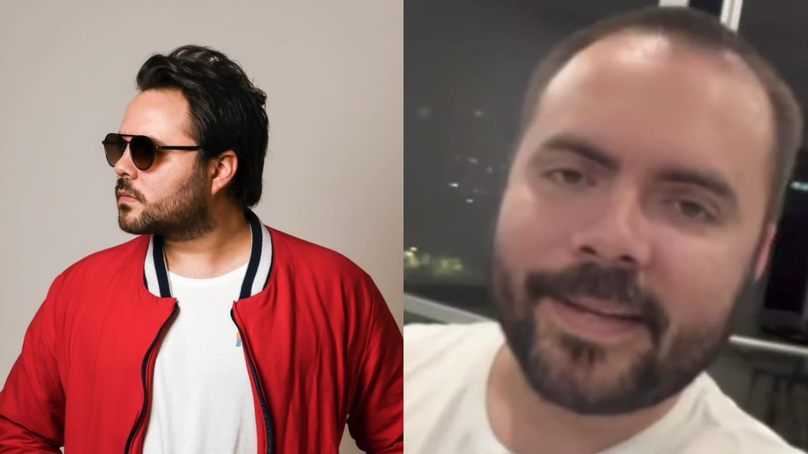 Mau Madriz implante de cabello