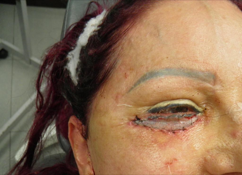 Como el párpado no le cerraba, la córnea se le resecaba y corría peligro su vista. Foto: Reiner Montero.