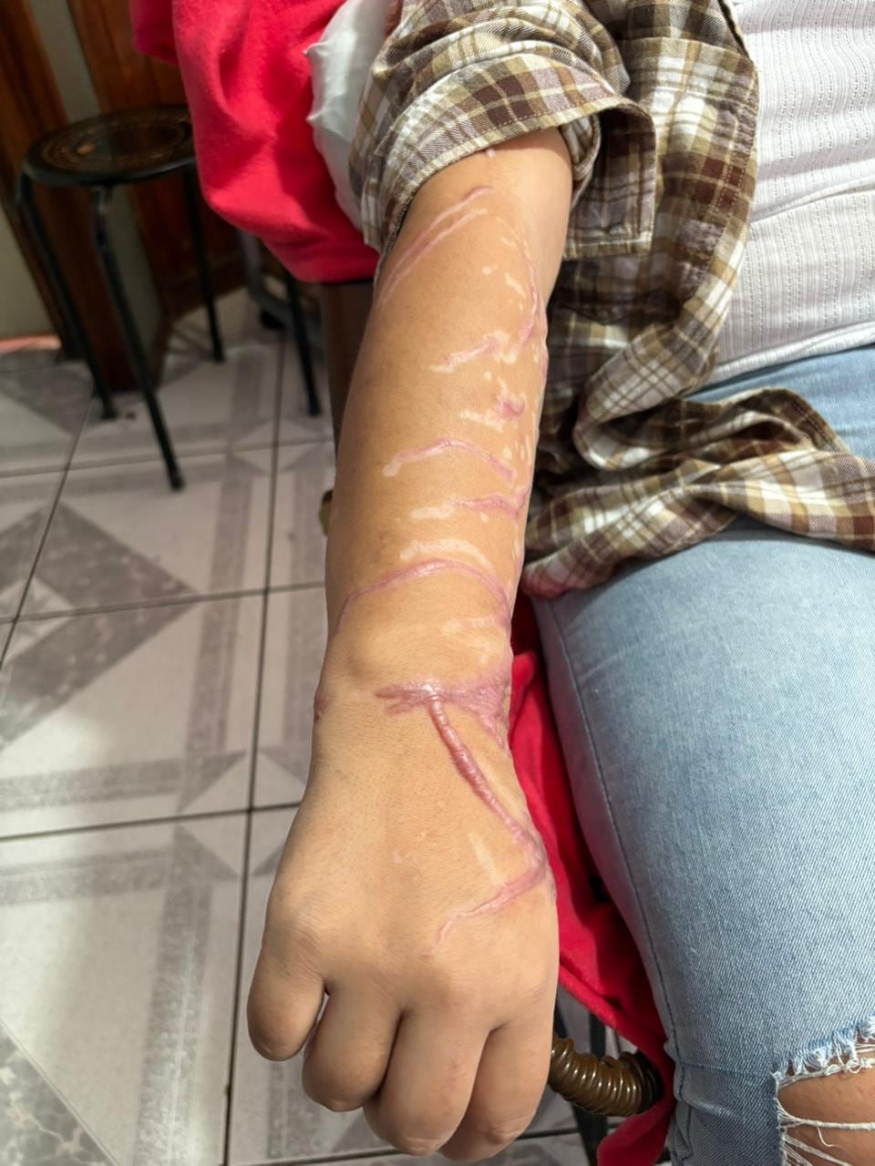 Jocelyn Ivannia Vallejos asegura que el proceso de recuperación por las quemaduras con ácido ha sido muy lento.