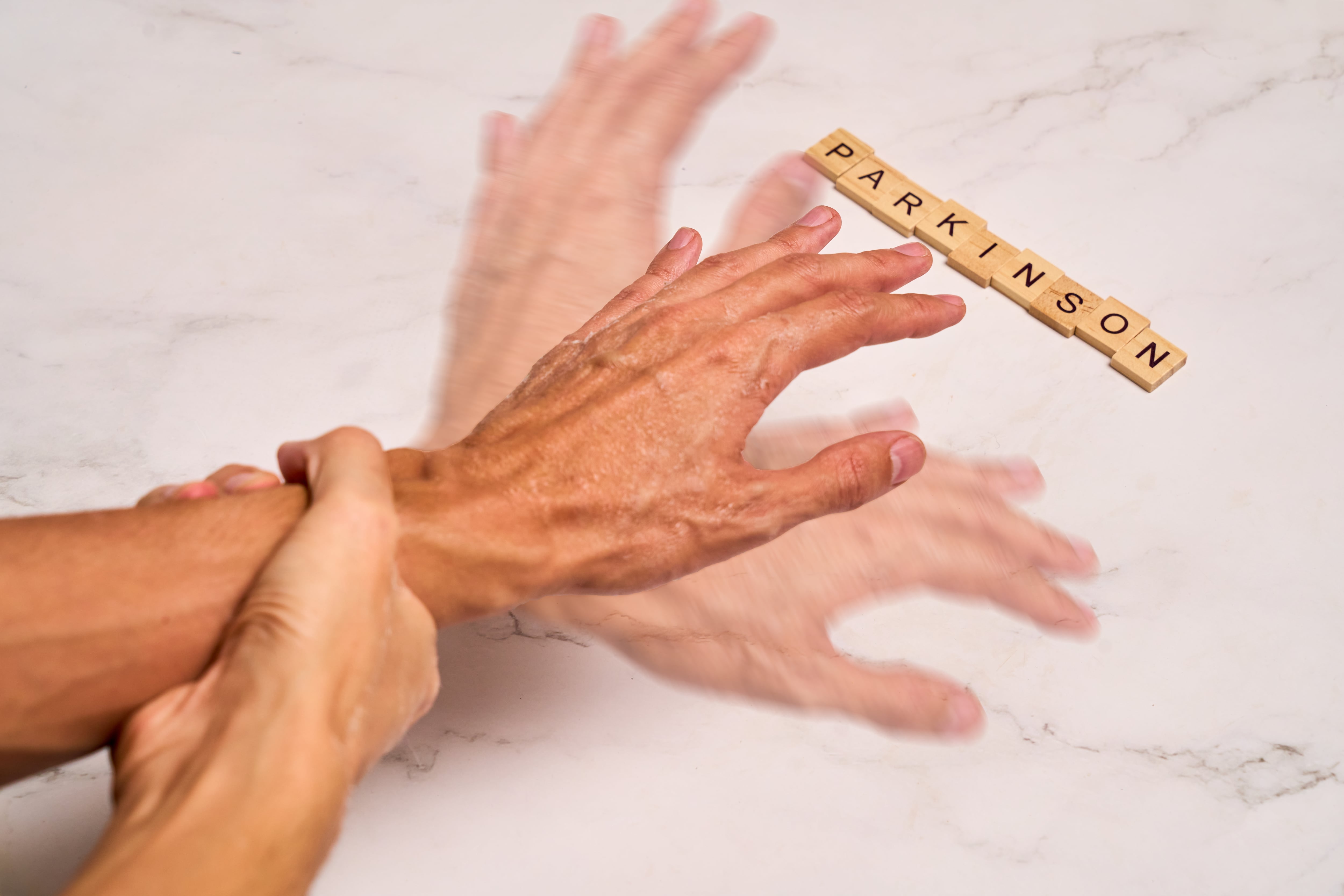 El Parkinson es la segunda enfermedad más común entre adultos mayores, afectando a 4-5 millones de personas mayores de 50 años en todo el mundo, según el Centro de Investigación en Neurociencias (CIN) de la UCR