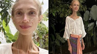 Joven muere pesando 23 kilos por radical decisión; esto fue lo que pasó