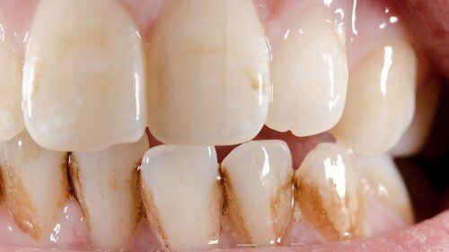 Sarro en los dientes