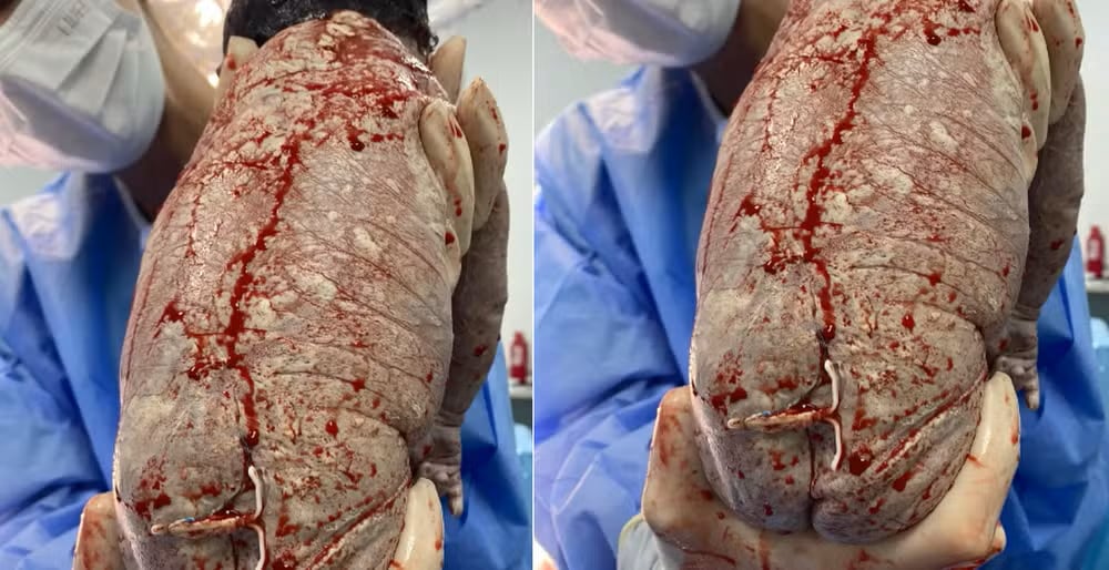 El bebé nació con el DIU adherido al cuerpo y el caso sorprendió por la rareza del suceso, aunque no implicó riesgos.