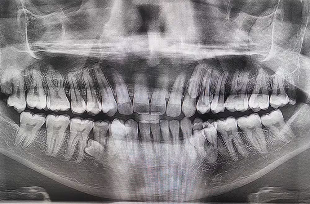 Un malayo logró un récord Guinness al registrar 42 dientes en su boca. La cifra supera por diez el promedio humano y se relaciona con hiperdontia.