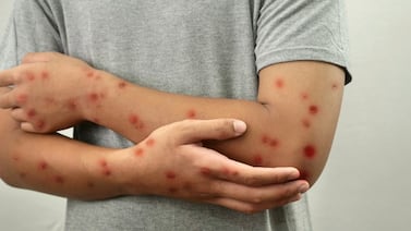 La epidemia que revolcó a México: ¿Cómo se dio un brote de sarampión con 25 muertes?