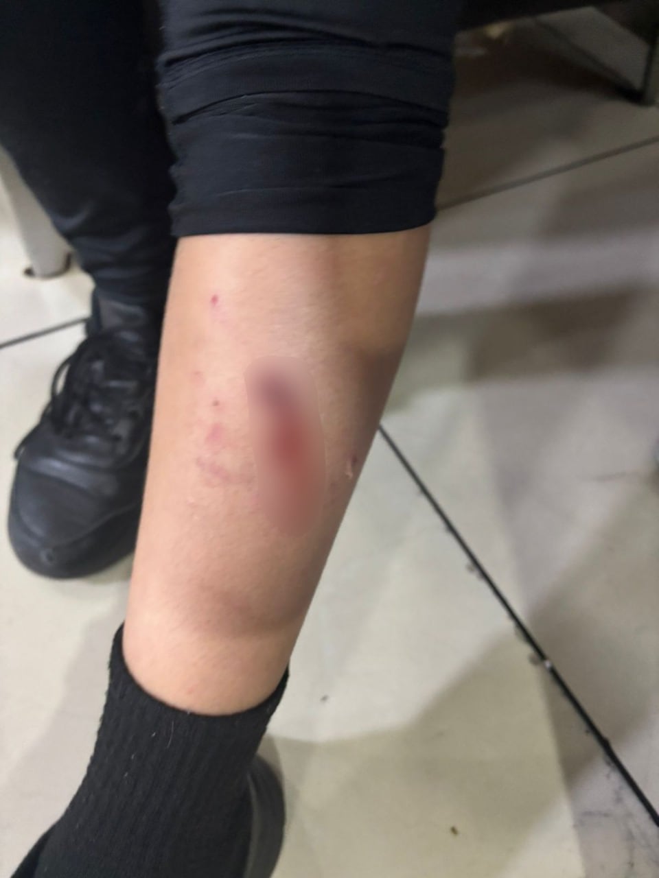 Imagen de identidad protegida de niño atacado por un perro en centro comercial